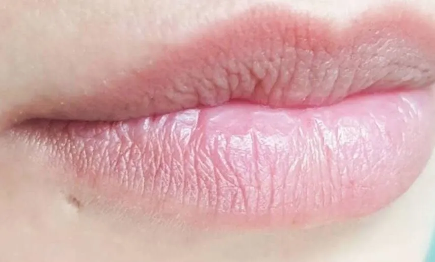 Labios: antes